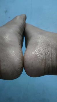 Product Review of tumitku obat kaki Kapalan from d**5 0