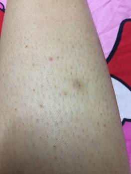 Product Review of Kela Lotion Thái Lan Dành Cho Da Viêm Lỗ Chân Lông 30ml/60ml from 5** t**i t** l** c**g 😮** 0
