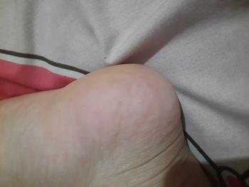 Product Review of tumitku obat kaki Kapalan from f**u 1