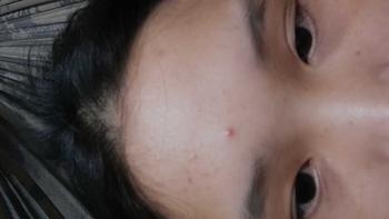 Product Review of [Mã 3] Mua 1 Tặng 1, ACNE SERUM - Serum Diếp Cá 5ml Hỗ Trợ Cải Thiện Mụn - Thương Hiệu: LE'PEAU from e**t s**n ** 2