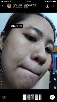 Product Review of [Mã 3] Mua 1 Tặng 1, ACNE SERUM - Serum Diếp Cá 5ml Hỗ Trợ Cải Thiện Mụn - Thương Hiệu: LE'PEAU from K** T**c 0