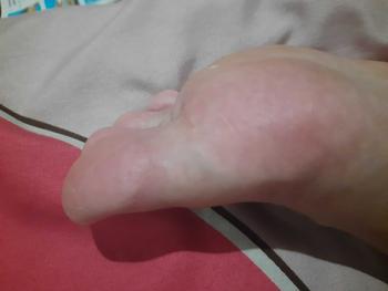 Product Review of tumitku obat kaki Kapalan from f**u 3