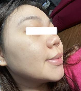 Product Review of [Mã 3] Mua 1 Tặng 1, ACNE SERUM - Serum Diếp Cá 5ml Hỗ Trợ Cải Thiện Mụn - Thương Hiệu: LE'PEAU from H**g t** 2