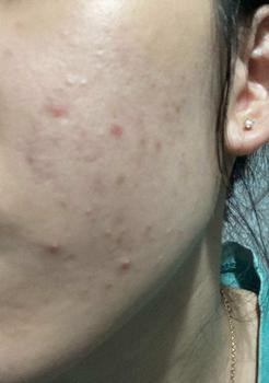 Product Review of [Mã 3] Mua 1 Tặng 1, ACNE SERUM - Serum Diếp Cá 5ml Hỗ Trợ Cải Thiện Mụn - Thương Hiệu: LE'PEAU from N**n T** L** A** 2