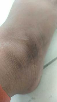 Product Review of tumitku obat kaki Kapalan from v**3 0