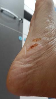Product Review of tumitku obat kaki Kapalan from l**a 0