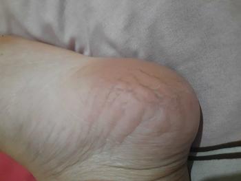 Product Review of tumitku obat kaki Kapalan from f**u 0