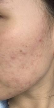 Product Review of [Mã 3] Mua 1 Tặng 1, ACNE SERUM - Serum Diếp Cá 5ml Hỗ Trợ Cải Thiện Mụn - Thương Hiệu: LE'PEAU from n**h 1