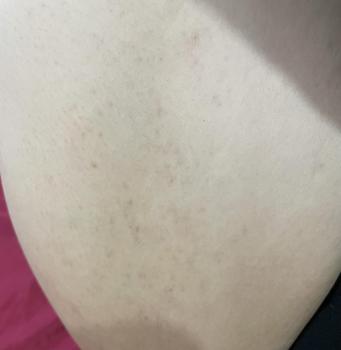 Product Review of Kem chấm mụn Mông mụn Lưng Molazin Skincare from b**🎀 0