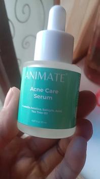Product Review of Animate Acne Care Serum 20 ml from Z**a A**a 0