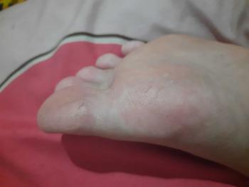Product Review of tumitku obat kaki Kapalan from f**u 2