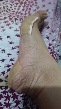 Product Review of tumitku obat kaki Kapalan from W**m 0