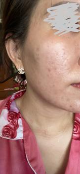 Product Review of [Mã 3] Mua 1 Tặng 1, ACNE SERUM - Serum Diếp Cá 5ml Hỗ Trợ Cải Thiện Mụn - Thương Hiệu: LE'PEAU from ** c**🍒 3