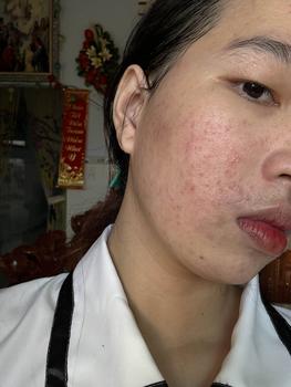 Product Review of [Mã 3] Mua 1 Tặng 1, ACNE SERUM - Serum Diếp Cá 5ml Hỗ Trợ Cải Thiện Mụn - Thương Hiệu: LE'PEAU from M** h**g v** 1