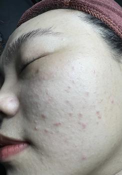 Product Review of [Mã 3] Mua 1 Tặng 1, ACNE SERUM - Serum Diếp Cá 5ml Hỗ Trợ Cải Thiện Mụn - Thương Hiệu: LE'PEAU from H**g t** 0
