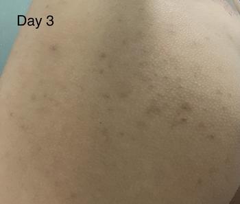 Product Review of Kem chấm mụn Mông mụn Lưng Molazin Skincare from n**₊ 2