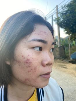 Product Review of [Mã 3] Mua 1 Tặng 1, ACNE SERUM - Serum Diếp Cá 5ml Hỗ Trợ Cải Thiện Mụn - Thương Hiệu: LE'PEAU from T**m N**n 1