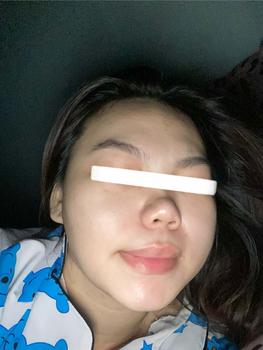 Product Review of [Mã 3] Mua 1 Tặng 1, ACNE SERUM - Serum Diếp Cá 5ml Hỗ Trợ Cải Thiện Mụn - Thương Hiệu: LE'PEAU from H**g t** 3