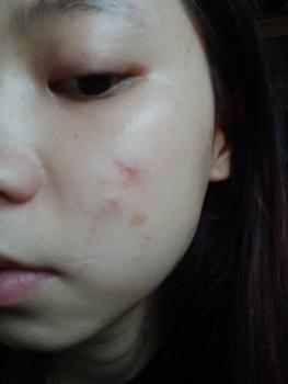 Product Review of [Mã 3] Mua 1 Tặng 1, ACNE SERUM - Serum Diếp Cá 5ml Hỗ Trợ Cải Thiện Mụn - Thương Hiệu: LE'PEAU from C** h** k**🦀 0