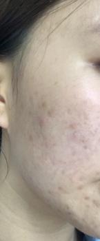 Product Review of [Mã 3] Mua 1 Tặng 1, ACNE SERUM - Serum Diếp Cá 5ml Hỗ Trợ Cải Thiện Mụn - Thương Hiệu: LE'PEAU from n**h 3