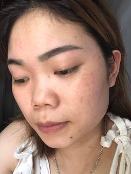 Product Review of [Mã 3] Mua 1 Tặng 1, ACNE SERUM - Serum Diếp Cá 5ml Hỗ Trợ Cải Thiện Mụn - Thương Hiệu: LE'PEAU from T**m N**n 3