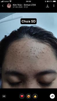 Product Review of [Mã 3] Mua 1 Tặng 1, ACNE SERUM - Serum Diếp Cá 5ml Hỗ Trợ Cải Thiện Mụn - Thương Hiệu: LE'PEAU from K** T**c 1
