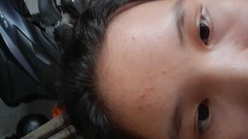 Product Review of [Mã 3] Mua 1 Tặng 1, ACNE SERUM - Serum Diếp Cá 5ml Hỗ Trợ Cải Thiện Mụn - Thương Hiệu: LE'PEAU from e**t s**n ** 1