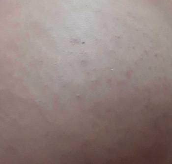 Product Review of Kem chấm mụn Mông mụn Lưng Molazin Skincare from Y** N** 0