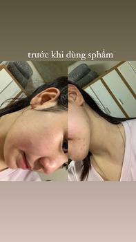 Product Review of [Mã 3] Mua 1 Tặng 1, ACNE SERUM - Serum Diếp Cá 5ml Hỗ Trợ Cải Thiện Mụn - Thương Hiệu: LE'PEAU from A** 0