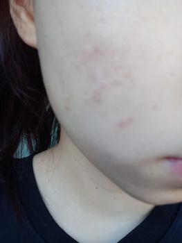 Product Review of [Mã 3] Mua 1 Tặng 1, ACNE SERUM - Serum Diếp Cá 5ml Hỗ Trợ Cải Thiện Mụn - Thương Hiệu: LE'PEAU from C** h** k**🦀 3