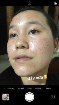 Product Review of [Mã 3] Mua 1 Tặng 1, ACNE SERUM - Serum Diếp Cá 5ml Hỗ Trợ Cải Thiện Mụn - Thương Hiệu: LE'PEAU from t**i 2