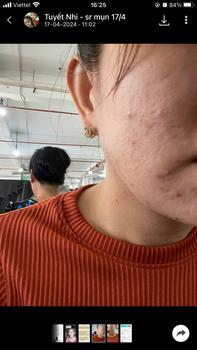 Product Review of [Mã 3] Mua 1 Tặng 1, ACNE SERUM - Serum Diếp Cá 5ml Hỗ Trợ Cải Thiện Mụn - Thương Hiệu: LE'PEAU from ** c**🍒 0