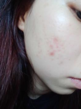 Product Review of [Mã 3] Mua 1 Tặng 1, ACNE SERUM - Serum Diếp Cá 5ml Hỗ Trợ Cải Thiện Mụn - Thương Hiệu: LE'PEAU from C** h** k**🦀 2