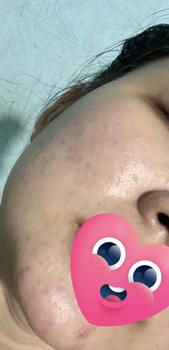 Product Review of KEM MỤN BUSTER 20G - Kim Mỹ Kim - Kem Hỗ Trợ Da Mụn - Net 20g Chăm Sóc Da Skincare Làm Đẹp Da Nữ Dưỡng Ẩm Da from Đ**y 2