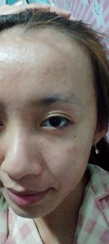 Product Review of [Mã 3] Mua 1 Tặng 1, ACNE SERUM - Serum Diếp Cá 5ml Hỗ Trợ Cải Thiện Mụn - Thương Hiệu: LE'PEAU from K** n**n 0