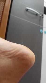 Product Review of tumitku obat kaki Kapalan from l**a 1