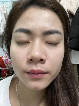 Product Review of [Mã 3] Mua 1 Tặng 1, ACNE SERUM - Serum Diếp Cá 5ml Hỗ Trợ Cải Thiện Mụn - Thương Hiệu: LE'PEAU from H** p**g c** T** T**g ❤**️ 2