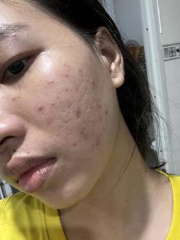 Product Review of [Mã 3] Mua 1 Tặng 1, ACNE SERUM - Serum Diếp Cá 5ml Hỗ Trợ Cải Thiện Mụn - Thương Hiệu: LE'PEAU from M** h**g v** 2