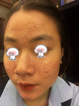 Product Review of [Mã 3] Mua 1 Tặng 1, ACNE SERUM - Serum Diếp Cá 5ml Hỗ Trợ Cải Thiện Mụn - Thương Hiệu: LE'PEAU from H** p**g c** T** T**g ❤**️ 0