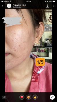 Product Review of [Mã 3] Mua 1 Tặng 1, ACNE SERUM - Serum Diếp Cá 5ml Hỗ Trợ Cải Thiện Mụn - Thương Hiệu: LE'PEAU from ** c**🍒 2