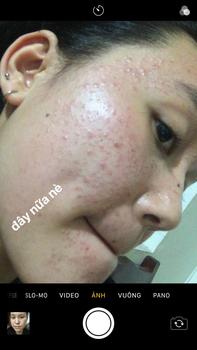 Product Review of [Mã 3] Mua 1 Tặng 1, ACNE SERUM - Serum Diếp Cá 5ml Hỗ Trợ Cải Thiện Mụn - Thương Hiệu: LE'PEAU from t**i 1