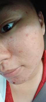 Product Review of [Mã 3] Mua 1 Tặng 1, ACNE SERUM - Serum Diếp Cá 5ml Hỗ Trợ Cải Thiện Mụn - Thương Hiệu: LE'PEAU from ** H** c**e ** 3