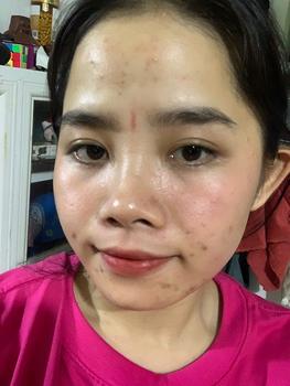 Product Review of [Mã 3] Mua 1 Tặng 1, ACNE SERUM - Serum Diếp Cá 5ml Hỗ Trợ Cải Thiện Mụn - Thương Hiệu: LE'PEAU from T**o ** 0
