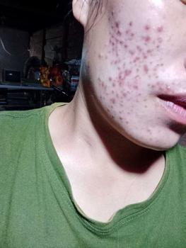 Product Review of Bundling Dermathib Suplemen Obat Jerawat & Acne Spot Treatment With Salicylic Acid dan Ceramide Totol Extract Memudarkan Niacinamide from T**A B** 0