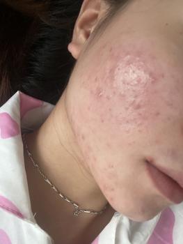 Product Review of [Mã 3] Mua 1 Tặng 1, ACNE SERUM - Serum Diếp Cá 5ml Hỗ Trợ Cải Thiện Mụn - Thương Hiệu: LE'PEAU from H** p**g c** T** T**g ❤**️ 1