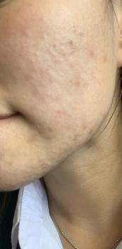 Product Review of [Mã 3] Mua 1 Tặng 1, ACNE SERUM - Serum Diếp Cá 5ml Hỗ Trợ Cải Thiện Mụn - Thương Hiệu: LE'PEAU from n**h 0