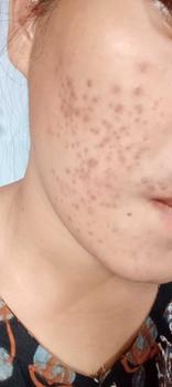 Product Review of Bundling Dermathib Suplemen Obat Jerawat & Acne Spot Treatment With Salicylic Acid dan Ceramide Totol Extract Memudarkan Niacinamide from T**A B** 2