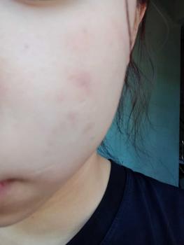 Product Review of [Mã 3] Mua 1 Tặng 1, ACNE SERUM - Serum Diếp Cá 5ml Hỗ Trợ Cải Thiện Mụn - Thương Hiệu: LE'PEAU from C** h** k**🦀 1
