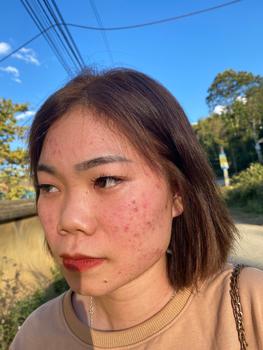 Product Review of [Mã 3] Mua 1 Tặng 1, ACNE SERUM - Serum Diếp Cá 5ml Hỗ Trợ Cải Thiện Mụn - Thương Hiệu: LE'PEAU from T**m N**n 0
