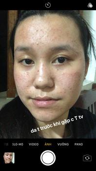 Product Review of [Mã 3] Mua 1 Tặng 1, ACNE SERUM - Serum Diếp Cá 5ml Hỗ Trợ Cải Thiện Mụn - Thương Hiệu: LE'PEAU from t**i 0
